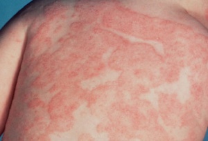 A megjelenése vörös foltok a bőrön okait és allergia kezelésére, viszkető foltok, miért, fotók