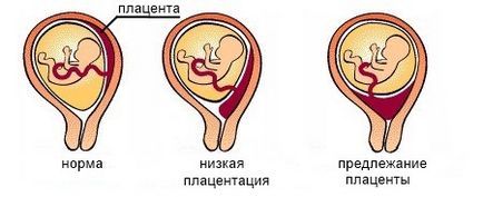 Placenta previa okoz, a tünetek, komplikációk