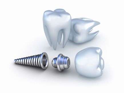 Jelei és tünetei elutasításának fő oka a fogászati ​​implantátum