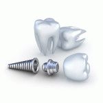 Jelei és tünetei elutasította a fogászati ​​implantátum fő oka