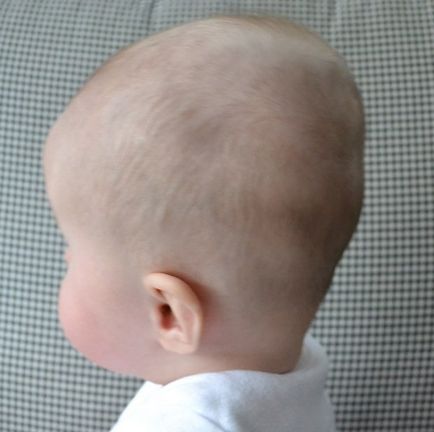 Angolkór csecsemők tünetei és kezelése Photo