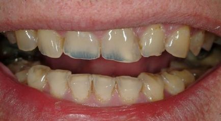 A megsemmisítés a zománc a fogak okoz, a tünetek, a külső tényezők, betegségek