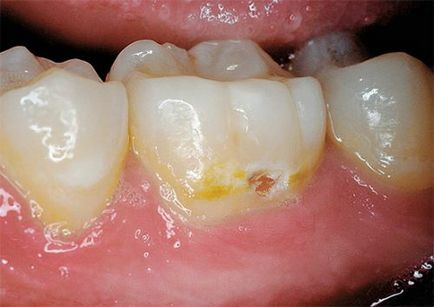 A megsemmisítés a zománc a fogak okoz, a tünetek, a külső tényezők, betegségek