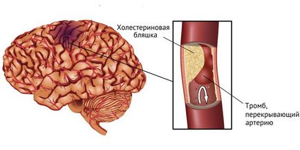 Heart Attack - Okok, hogyan lehet felismerni a tüneteket, és elsősegélyt nyújtani