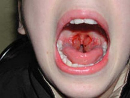 Tünetek és diagnózis orrpolip a gyermekek különböző korcsoportokban a fotók és videók