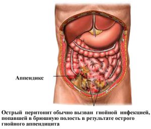 A hőmérséklet alatt és a kezelés után appendectomia