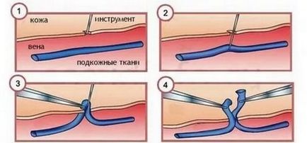 Visszér a lábakon, és miért kezelés a lábakon jelennek háló vénák