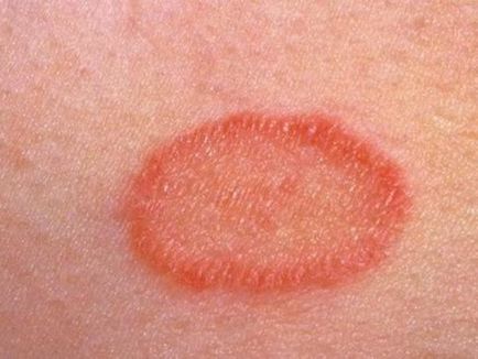 Bőrgyulladás típusok, okok, tünetek és a kezelés