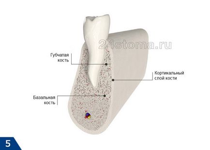 Bazális implantátumok - áttekinti a előnyeiről és hátrányairól, az ár 2017