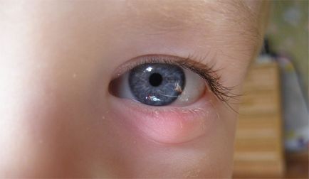 Szemkenőcs tetraciklin - használati utasítás (alkalmazás) Eye tetraciklin kenőcs - használati utasítás