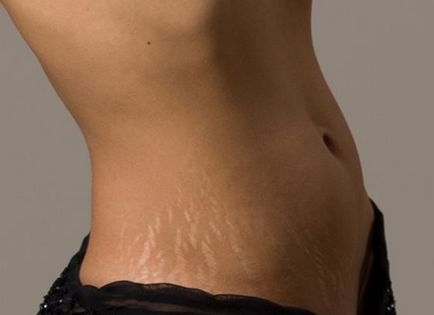 Hogyan lehet megszabadulni a striák, a válaszokat a kérdéseidre (striák otthon) Hogyan lehet megszabadulni a striák, a választ kérdéseire