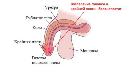 Hogyan kell kezelni balanoposthitis otthon (home) Hogyan kell kezelni balanoposthitis otthon