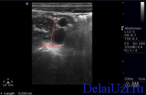 Lehetséges azonosítani vakbélgyulladás ultrahanggal függelék