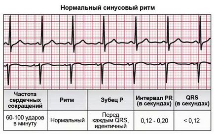 Sinus ritmus a szív, hogy mit jelent, felvételi EKG