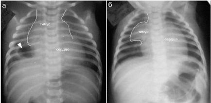 Uzi csecsemőmirigy (thymus), mi ez, miért van szükség