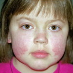 Lupus fotó, a tünetek és a kezelés a betegség (kezelés) Lupus fotó, tünetei és kezelése a betegség