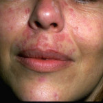 Lupus fotó, a tünetek és a kezelés a betegség (lupus) Lupus fotó, tünetei és kezelése a betegség