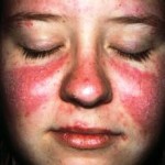 Lupus fotó, a tünetek és a kezelés a betegség (az ok) Lupus fotó, tünetei és kezelése a betegség