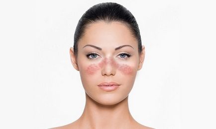 Lupus fotó, tünetek és a kezelés a betegség (betegség) Lupus fotó, tünetei és kezelése a betegség