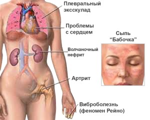Lupus fotó, a tünetek és a kezelés a betegség (tünet) Lupus fotó, tünetei és kezelése a betegség