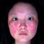 Lupus fotó, a tünetek és a kezelés a betegség (tünetek) Lupus fotó, tünetei és kezelése a betegség