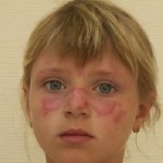 Lupus fotó, a tünetek és a kezelés a betegség (tünet) Lupus fotó, tünetei és kezelése a betegség