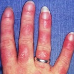 Lupus fotó, tünetek és a kezelés a betegség (betegség) Lupus fotó, tünetei és kezelése a betegség