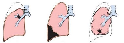 Tüdő atelectasia okok, tünetek, kezelés