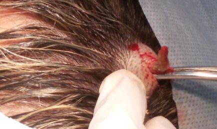 Atheroma (fotók) - Tünetek, kezelés és ártalmatlanítás (fotók) Atheroma (fotók) - Tünetek, kezelés és ártalmatlanítás