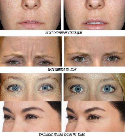 Botox az arc - áttekinti az eljárást, és a lehetséges következmények