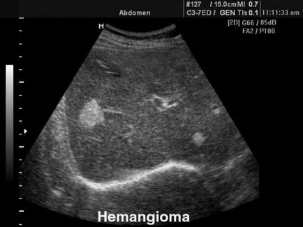 Mi az a máj kezelésére hemangióma, okok, fényképek és vélemények