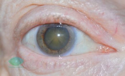 Kettős látás - okok, tünetek, kezelés