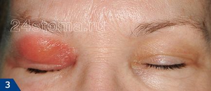 Ethmoiditis - tünetek és kezelés a felnőtt, antibiotikum, cseppek (antibiotikumok) Ethmoiditis - tünetek és kezelés felnőtteknek, antibiotikumok, cseppek