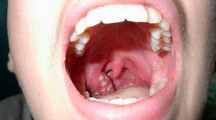 Tonsillitis okok, tünetek és a kezelés
