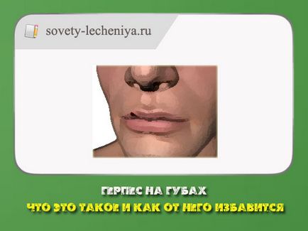 Herpesz az ajkakon, mi ez, és hogyan lehet megszabadulni (ajak) is Herpesz az ajkakon, mi ez, és hogyan lehet megszabadulni tőle