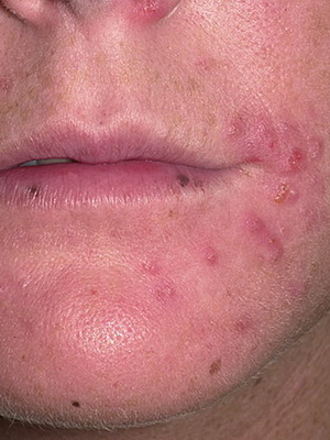 Fertőző betegségek, a bőr és a haj okai, tünetei a gombás fertőzések a bőr és