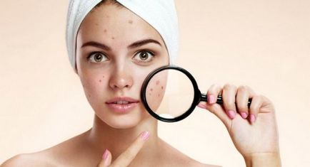 Hogyan lehet gyorsan távolítsa el a pattanások a homlokán néhány tipp a bőrgyógyász az Ön számára