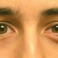 Hogyan lehet gyorsan eltávolítani a fekete szem (fekete szem egy ütés)