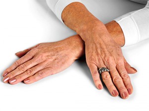 Hogyan lehet megszabadulni a kor foltok a kezét az idősek