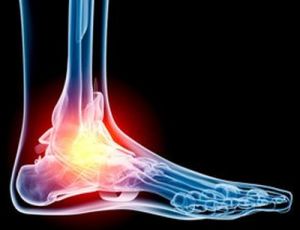 Hogyan kell kezelni osteoarthritis a láb otthon és hagyományosan, fotó patológia