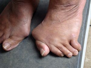 Hogyan kell kezelni osteoarthritis a láb otthon és hagyományosan, fotó patológia