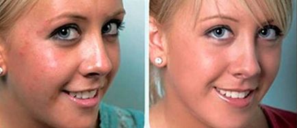 Hogyan lehet eltávolítani a nyomait pattanások az arcon egyedül