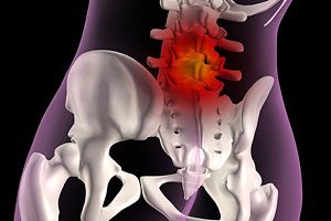 Kezelése porckorongsérv spinális lumboszakrális konzervatív és operatív