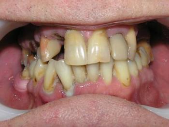 periodontitis otthoni kezelés () fogágybetegség kezelés otthon