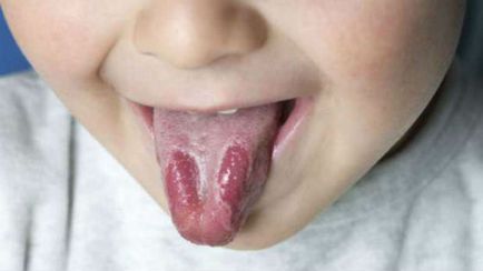 A szájpenész a baba szájába tünetek, fotó, alakzatok, kezelés, megelőzés szájpenész