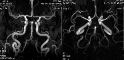 MRI szakértő, MR angiográfia a tanulmány agyi artériák