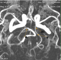 MRI szakértő, MR angiográfia a tanulmány agyi artériák