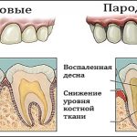 A periodontális betegség tünetei és kezelése otthon