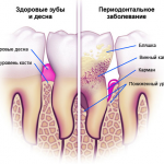 A periodontális betegség tünetei és kezelése otthon