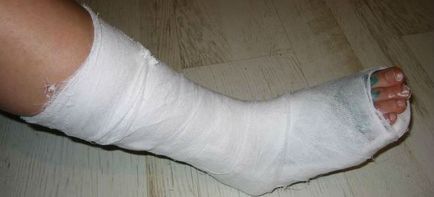 Törés a lábközépcsont csont a láb - tünetek, kezelés, rehabilitáció törés után lábközépcsontok